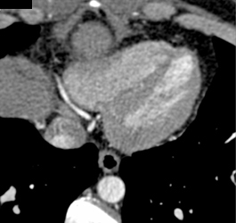 Normal LAD and RCA - CTisus CT Scan