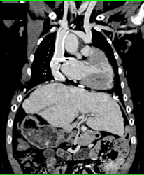 Cardiac Shunt in Patient With Congenital Heart Disease - CTisus CT Scan