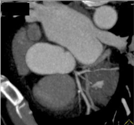 Stenosis in Circumflex Coronary Artery - CTisus CT Scan