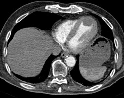 Prior Left Ventricular Infarct - CTisus CT Scan