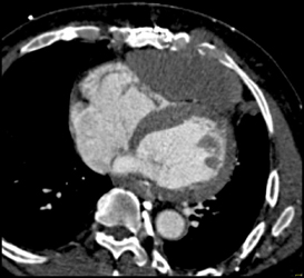 Mass Pushes on Ventricle-path Pending - CTisus CT Scan