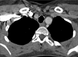 Prominent Arch on Left With High Takeoff of Vessels - CTisus CT Scan