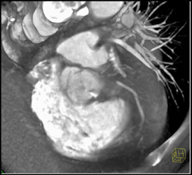 Calcifications in Aortic Valve - CTisus CT Scan