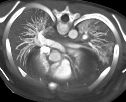 Posterior Positioned Left Coronary Artery - CTisus CT Scan