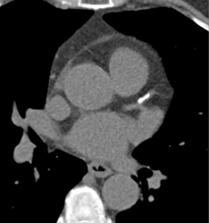 Calcified LAD With Stenosis-see CTA - CTisus CT Scan