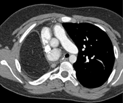 Absent Right Pulmonary Aa - CTisus CT Scan