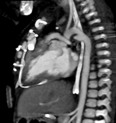 Prominent Ductus in Patient With Chd - CTisus CT Scan