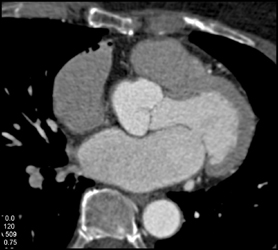 Plaque in Left Main Coronary Aa - CTisus CT Scan