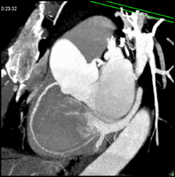 Minimal RCA Disease - CTisus CT Scan