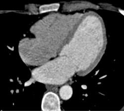 Thin Apex of Left Ventricle - CTisus CT Scan