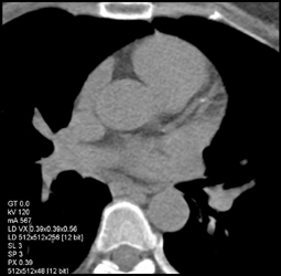 Plaque in LAD and RCA - CTisus CT Scan