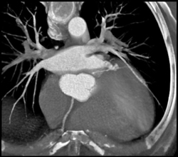 Diseased Left Coronary Aa System - CTisus CT Scan