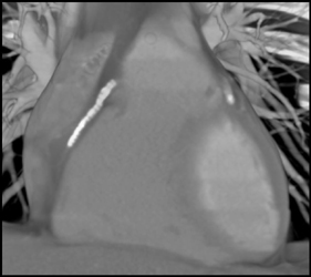 Extensive Plaque RCA - CTisus CT Scan