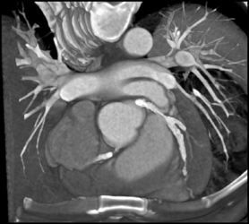 Extensive Plaque in Left Main LAD and Circumflex - CTisus CT Scan