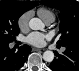 Significant Narrowing of LAD - CTisus CT Scan