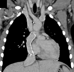 Congenital Heart Disease With A Fontain Shunt - CTisus CT Scan