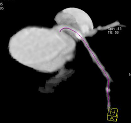 Plaque in LAD With Circulation Software - CTisus CT Scan