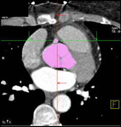 RCA Evaluation With Circulation Software - CTisus CT Scan