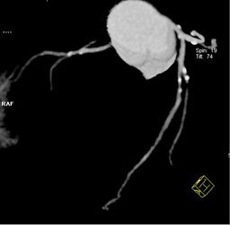 LAD Evaluation With Circulation Software Demonstrates Calcified Plaque - CTisus CT Scan