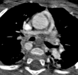 Reconstructed Pulmonary Arteries - CTisus CT Scan