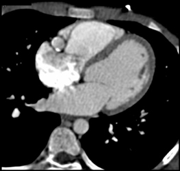 Coronary Artery Aneurysm Due to Kawasakis Disease - CTisus CT Scan