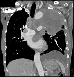 Lung Cancer Invades the Left Atrium - CTisus CT Scan