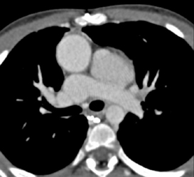 Repaired Transposition of the Great Vessels - CTisus CT Scan