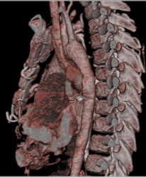 Chd With Collaterals - CTisus CT Scan