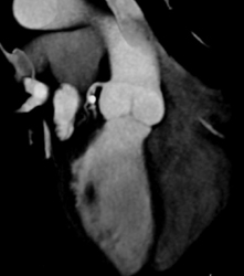 Calcified Plaque With Stenosis in LAD - CTisus CT Scan