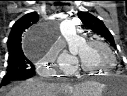 Post-op Seroma Compresses Stent - CTisus CT Scan