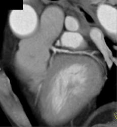 Soft Plaque Circumflex - CTisus CT Scan