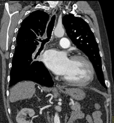 Tumor Encases Mediastinum Including Trachea and Right Pulmonary Artery - CTisus CT Scan