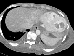 Thrombi in Left Ventricle - CTisus CT Scan