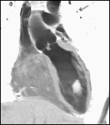 Tumor in Left Ventricle-incidental Finding - CTisus CT Scan