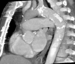 Aortic Arch Repair - CTisus CT Scan