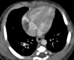 Benign Cardiac Tumor in Right Atrium - CTisus CT Scan