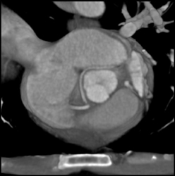 Circumflex Arises Off the RCA - CTisus CT Scan