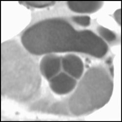 Tricuspid Valve - CTisus CT Scan