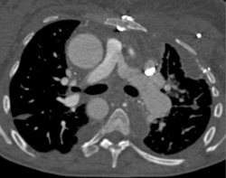 Right Arch With Prior Coarctation - CTisus CT Scan