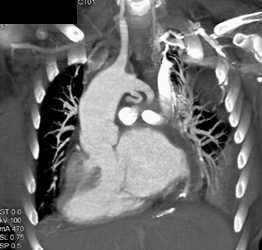 Small Descending Aorta - CTisus CT Scan