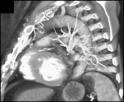 Left Internal Mammary Artery (LIMA) Bypass - CTisus CT Scan