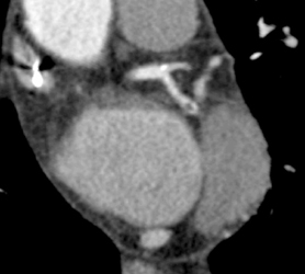 Clot in LAD - CTisus CT Scan