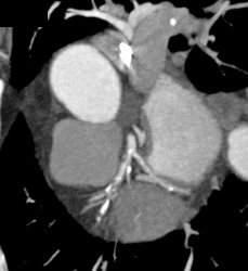 Greater Than 50% Stenosis LAD - CTisus CT Scan