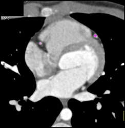 Right and Left Coronary Arteries Arise From A Single Cusp and Orifice - CTisus CT Scan