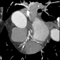 Near Occluded LAD - CTisus CT Scan