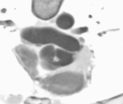 Vegetation Off Aortic Valve - CTisus CT Scan