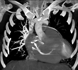 Patent Stent in Pulmonary Artery-see Sequence to Follow - CTisus CT Scan