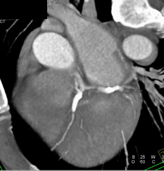 Stent in LAD and Circumflex - CTisus CT Scan