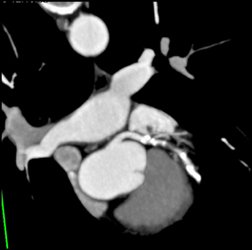 Disease in LAD With Stenosis - CTisus CT Scan