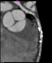 Diseased LAD With Greater Than 50% Stenosis With Soft Plaque - CTisus CT Scan